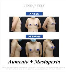 Mastopexia - Dr. Lenin Alfonso Reyes Ibarra