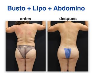 Liposucción - Dr. Lenin Alfonso Reyes Ibarra