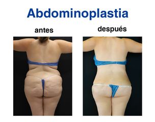 Liposucción - Dr. Lenin Alfonso Reyes Ibarra
