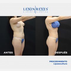 Lipoescultura - Dr. Lenin Alfonso Reyes Ibarra