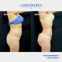 Lipoescultura - Dr. Lenin Alfonso Reyes Ibarra