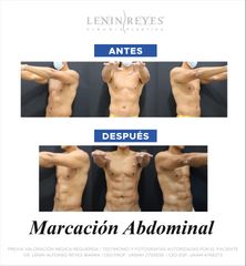 Marcación Abdominal - Dr. Lenin Alfonso Reyes Ibarra
