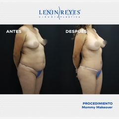 Abdominoplastia - Dr. Lenin Alfonso Reyes Ibarra