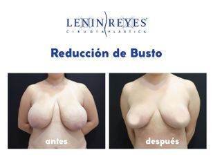 Reducción de mamas - Dr. Lenin Alfonso Reyes Ibarra