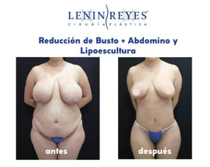 Reducción de mamas - Dr. Lenin Alfonso Reyes Ibarra