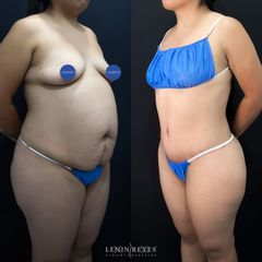 Abdominoplastia