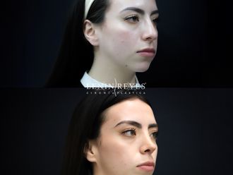 Rinoplastia antes y después - 879013