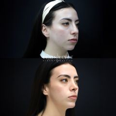 Rinoplastia