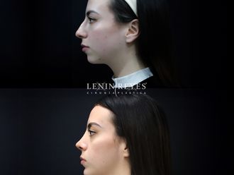 Rinoplastia antes y después - 879014