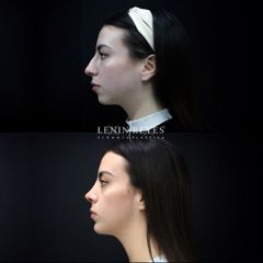 Rinoplastia
