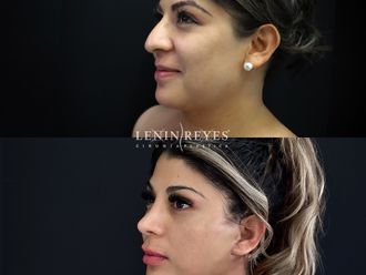 Rinoplastia antes y después - 879015