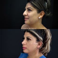 Rinoplastia