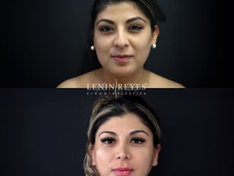 Rinoplastia antes y después - 879016