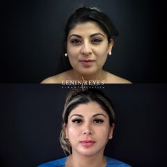 Rinoplastia
