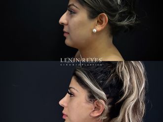 Rinoplastia antes y después - 879017
