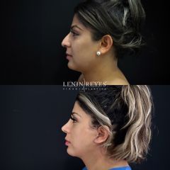 Rinoplastia