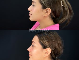 Rinoplastia antes y después - 879018