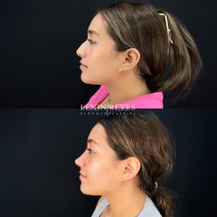 Rinoplastia