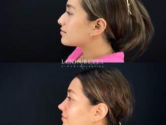 Rinoplastia antes y después - 879019