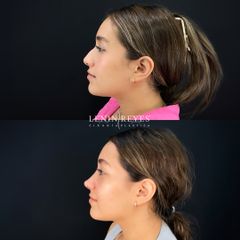 Rinoplastia