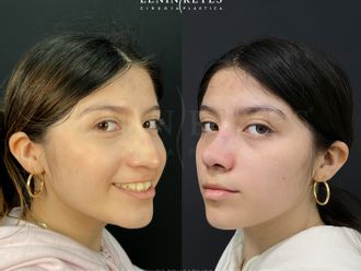 Rinoplastia antes y después - 879021
