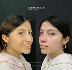 Rinoplastia