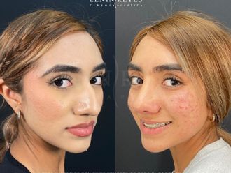 Rinoplastia antes y después - 879022