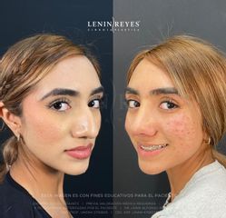 Rinoplastia