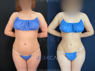 Lipoescultura antes y después - 879023