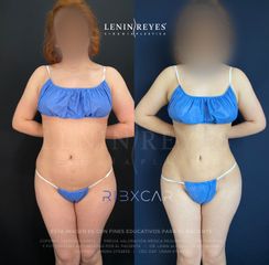 Lipoescultura