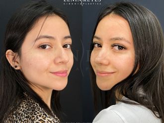 Rinoplastia antes y después - 879025