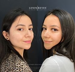 Rinoplastia