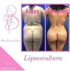 Antes y después de Lipoescultura