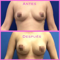 Antes y después de Aumento de busto