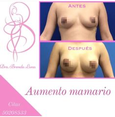 Antes y después de Aumento de busto