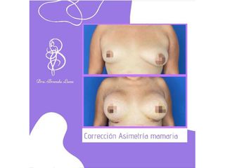 Antes y después de Mastopexia
