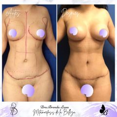 Antes y después de Lipoescultura
