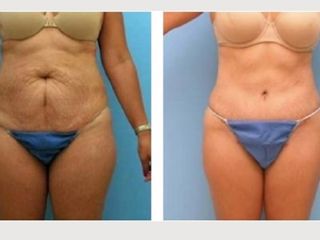 Antes y después de abdominoplastia