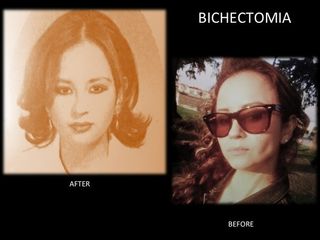 Antes y después de Bichectomia o reducción de mejillas