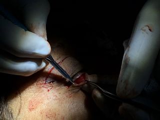 Blefaroplastia inferior