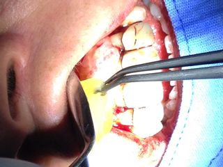 Plasma en odontología