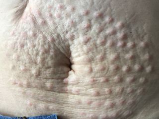 Mesoterapia