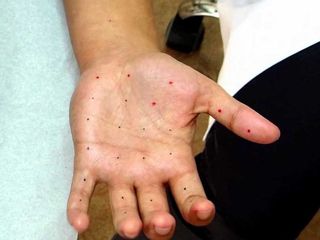 Sudoración excesiva toxina botulínica