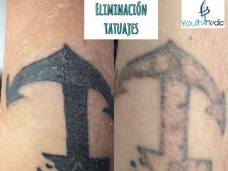 Antes y después de eliminación de tatuajes 