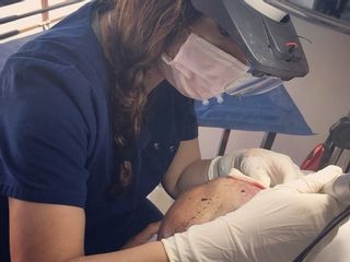 Transplante de Cabello 