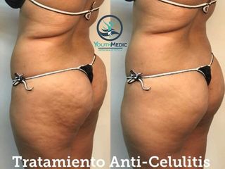 Antes y después de Carboxiterapia 