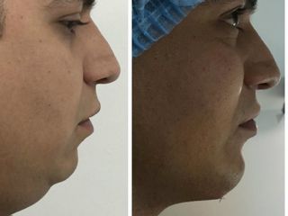 Antes y después de Cirugía de papada