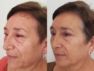 Blefaroplastia - 626524