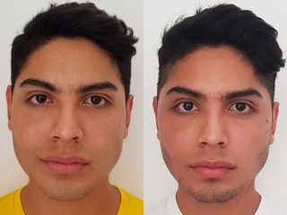 Antes y después de Lifting facial