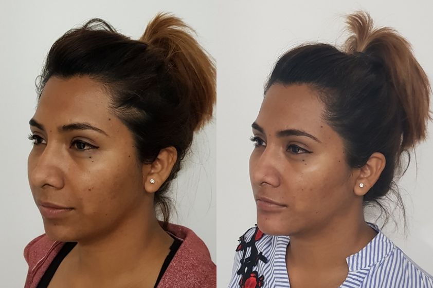 Mentoplastia antes y después - 632418